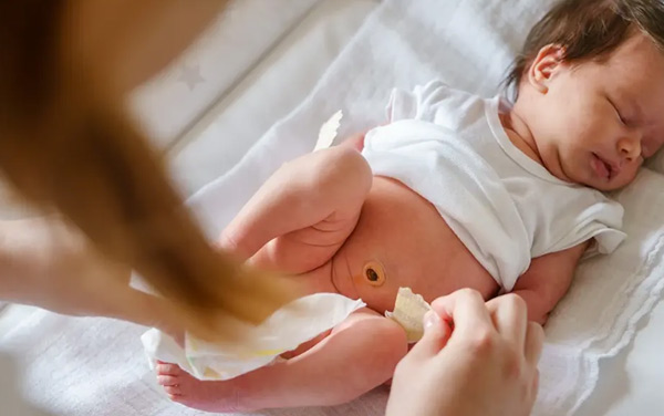 روش حلقه ختنه نوزادان