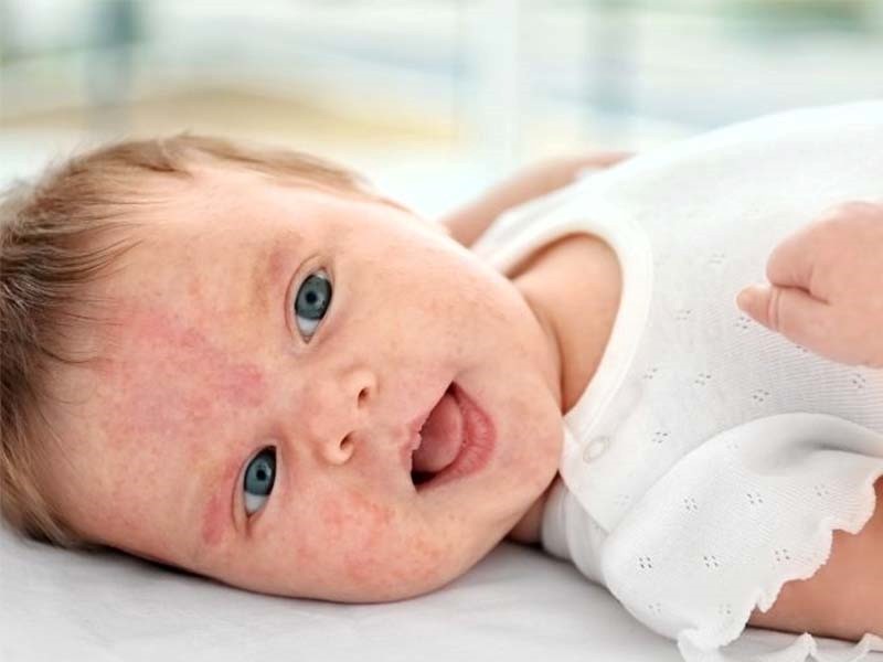علائم آلرژی در نوزادان