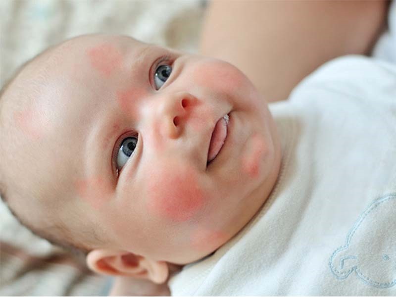 پیشگیری آلرژی در نوزادان