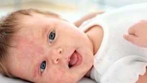 آلرژی نوزادان،کلینیک کودکان آنا