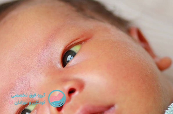 عکس زردی چشم نوزاد