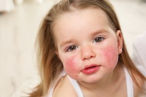 آلرژی در کودکان-کلینیک کودکان آنا