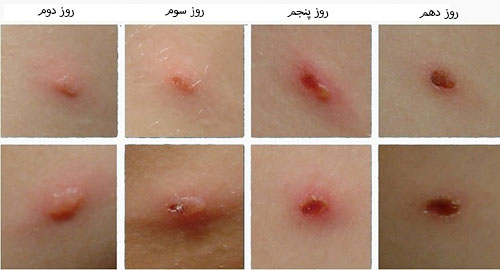 عکس آبله مرغان کودک