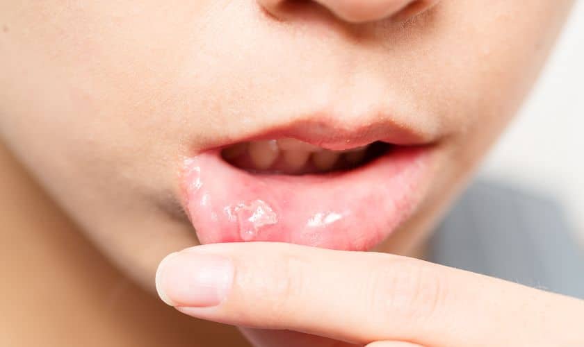 درمان سریع آفت دهان کودک