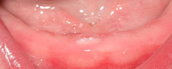 در آمدن دندان شیری نوزاد