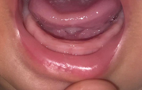 عکس دندون در آوردن نوزاد