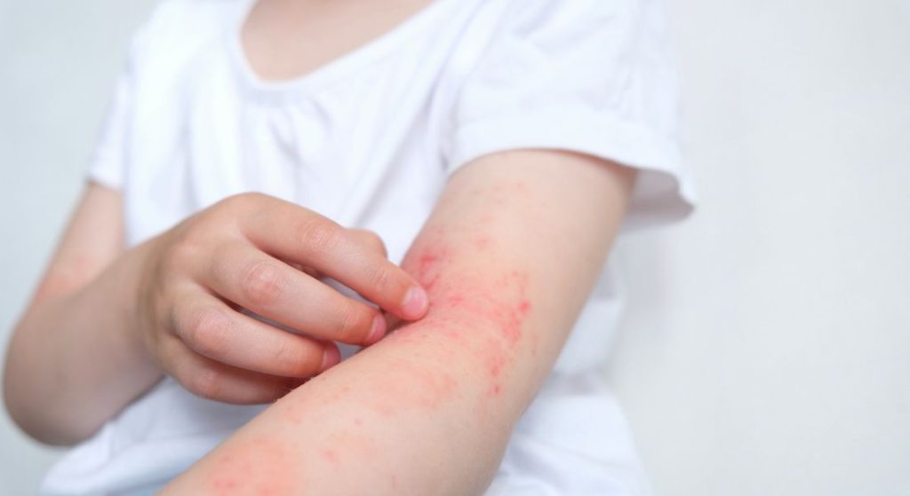 بهترین پماد حساسیت پوستی در کودکان - شربت حساسیت پوستی در کودکان