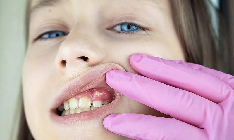 پیشگیری عفونت لثه در کودکان - درمان عفونت لثه در کودکان