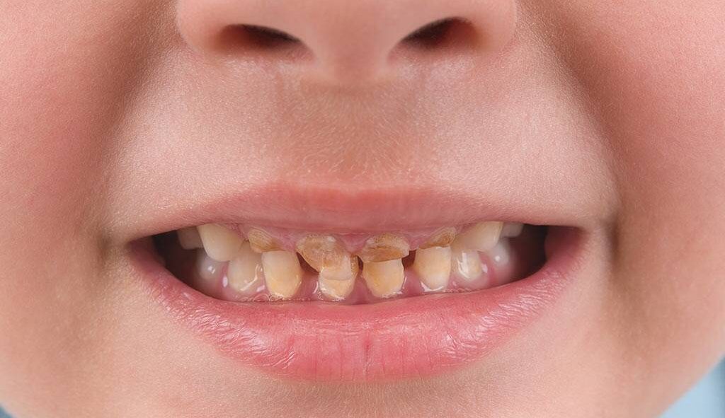 از بین بردن زردی دندان کودک در خانه