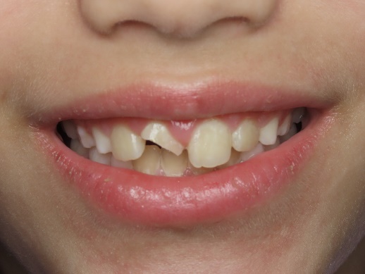 درمان شکستگی دندان جلو کودکان