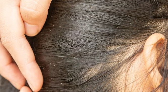 چگونه کودکان به شپش سر مبتلا میشوند؟