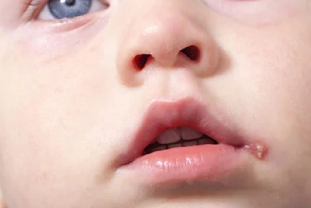 درمان تبخال دهانی کودک