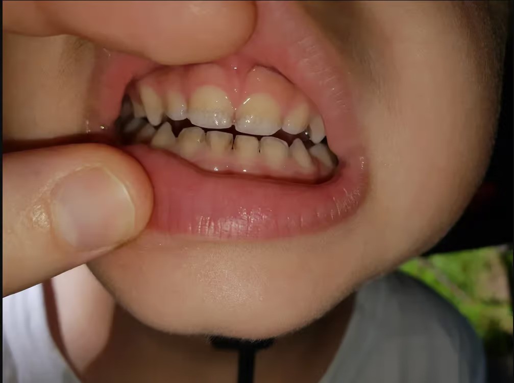 دلیل لکه‌های سفید روی دندان کودک