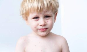 جوش زدن کودکان