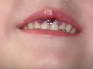 خونریزی لثه در کودکان